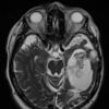 9B4 Cyst, epidermoid (Case 9) T2