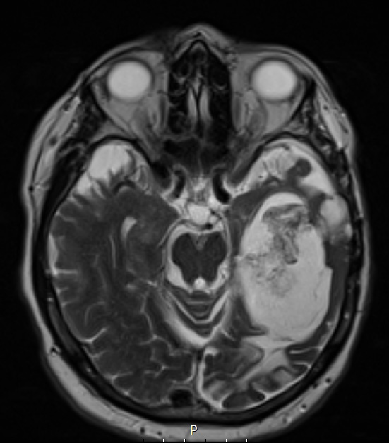 9B4 Cyst, epidermoid (Case 9) T2