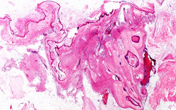 9C1 Cyst. epidermoid (Case 9) H&E 2X