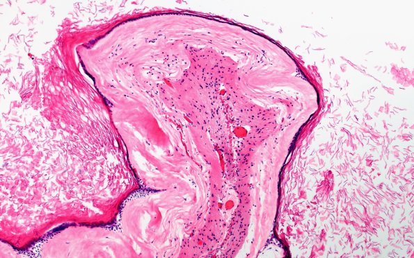 9C2 Cyst. epidermoid (Case 9) H&E 10X