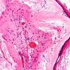 Cyst - Epidermoid