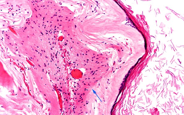 9C3 Cyst, epidermoid (Case 9) A