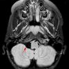 Cyst - Glioependymal