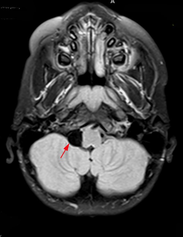 1A1 Cyst, Glioependymal (Case 1) FLAIR