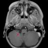 1A2 Cyst, Glioependymal (Case 1) T1 FL2D W 1