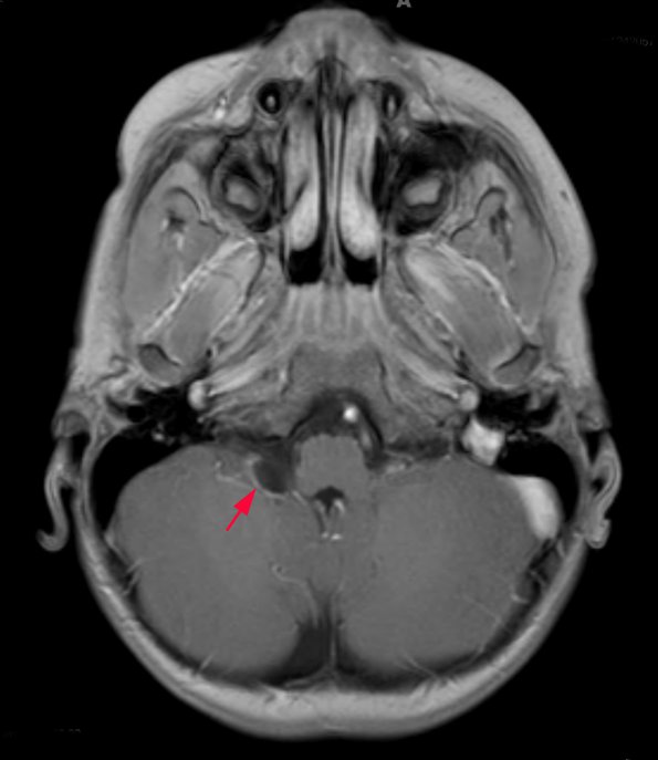 1A2 Cyst, Glioependymal (Case 1) T1 FL2D W 1