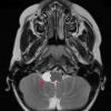 1A3 Cyst, Glioependymal (Case 1) T2 W