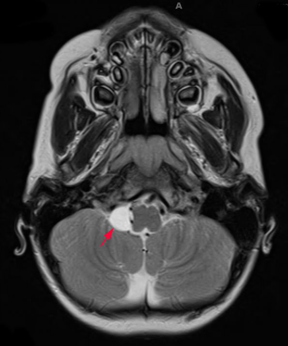 1A3 Cyst, Glioependymal (Case 1) T2 W