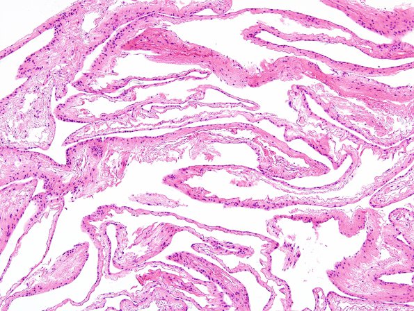 1B1 Cyst, Glioependymal (Case 1) H&E 1A