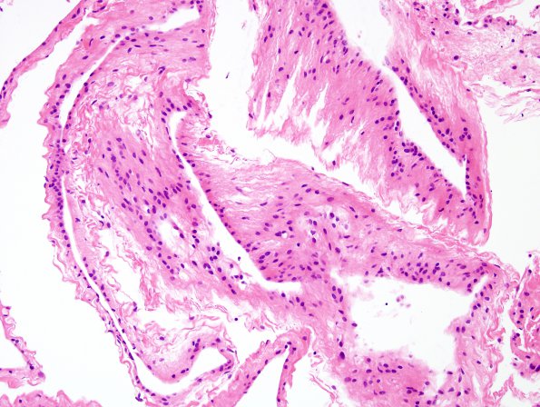 1B2 Cyst, Glioependymal (Case 1) H&E 2A