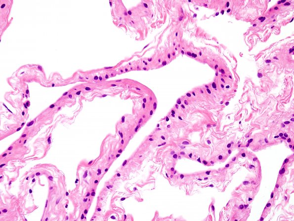 1B3 Cyst, Glioependymal (Case 1) H&E 3A