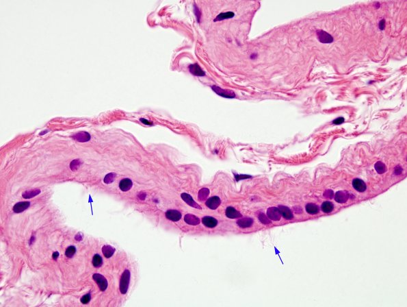 1B4 Cyst, Glioependymal (Case 1) H&E 5