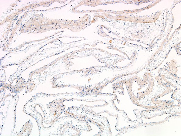 2 Cyst, glioependymal (Case 2) EMA