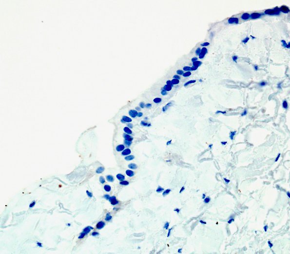 3 Cyst, Glioependymal (Case 3) CK