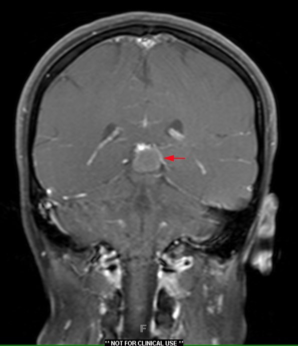 1A1 Cyst, pineal (Case 1) T1 FS W 1