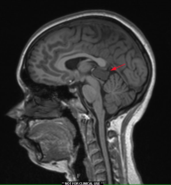 1A2 Cyst, pineal (Case 1) T1 MPRAGE 1