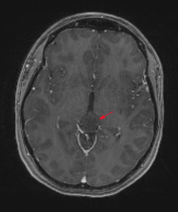 1A3 Cyst, pineal (Case 1) T1 POST 1