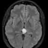 1A4 Cyst, pineal (Case 1) TIRM 2