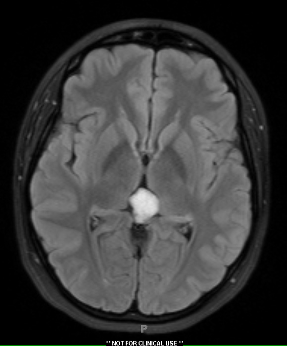 1A4 Cyst, pineal (Case 1) TIRM 2