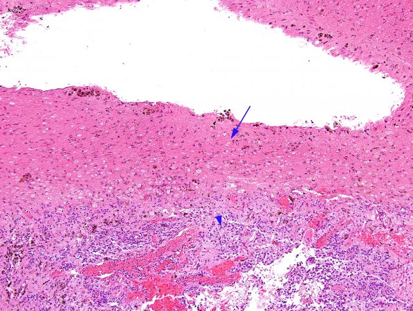 1B1 Cyst, pineal (Case 1) H&E 4