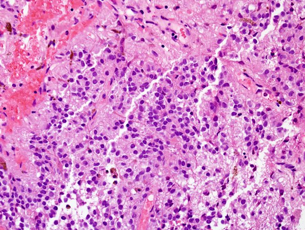 1B3 Cyst, pineal (Case 1) H&E 9