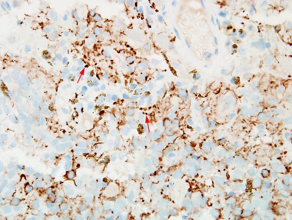 1C3 Cyst, pineal (Case 1) NF 5