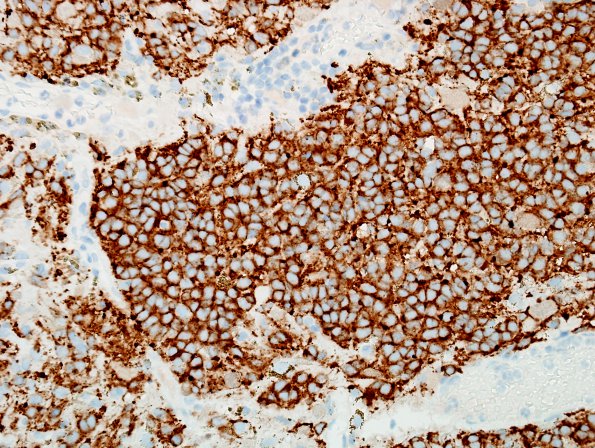 1C5 Cyst, pineal (Case 1) SYN 1