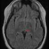 2A1 Cyst, Pineal (Case 2) T2 TIRM, Dark Fl 1 copy