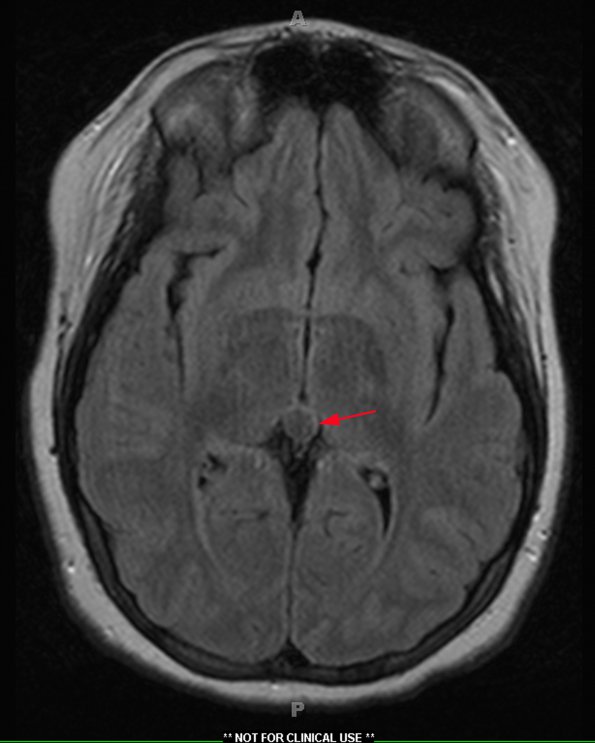 2A1 Cyst, Pineal (Case 2) T2 TIRM, Dark Fl 1 copy