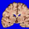 2B1 Cyst, pineal (Case 2) sudden death 1A