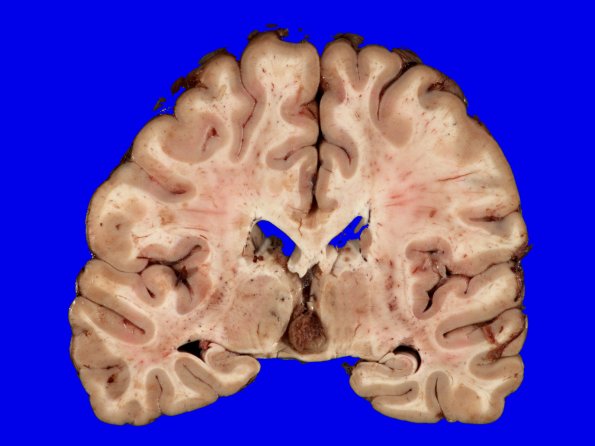 2B1 Cyst, pineal (Case 2) sudden death 1A