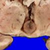 2B2 Cyst, pineal (Case 2) sudden death 3A