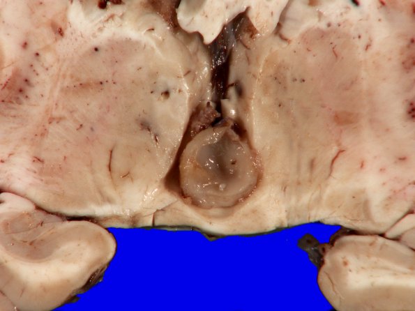 2B2 Cyst, pineal (Case 2) sudden death 3A