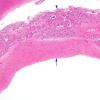 2C2 Cyst, pineal (Case 2) H&E 1 (patient, sudden death)