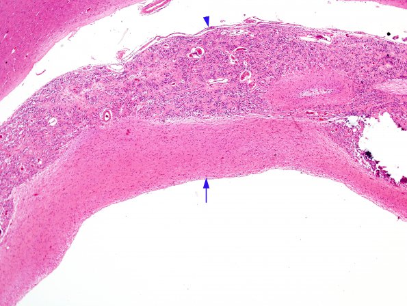 2C2 Cyst, pineal (Case 2) H&E 1 (patient, sudden death)