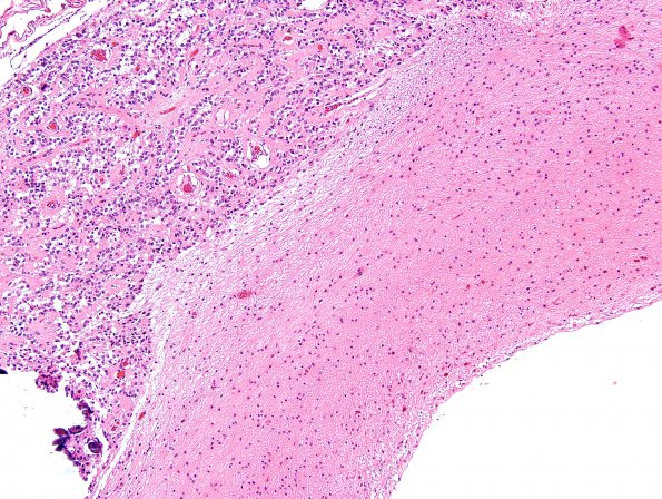 2C3 Cyst, pineal (Case 2) H&E 2