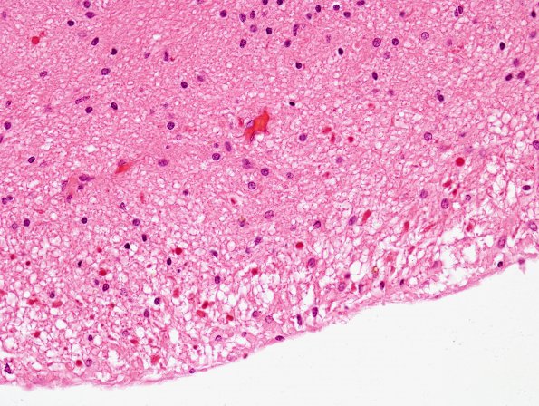 2C4 Cyst, pineal (Case 2) H&E 4