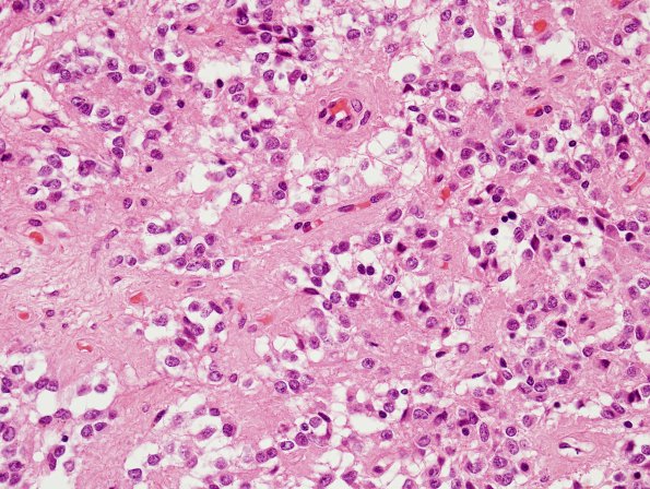 2C5 Cyst, pineal (Case 2) H&E 5