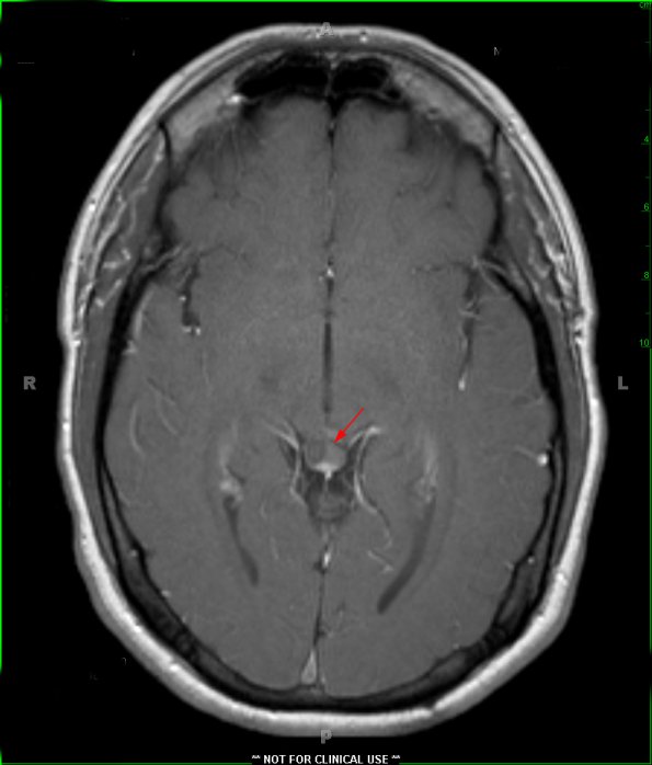 3A1 Cyst, pineal (Case 3) T1 BLADE W 5