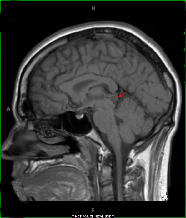 3A2 Cyst, pineal (Case 3) T1 BLADE W 7