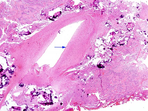 3B1 Cyst, pineal (Case 3) H&E 1