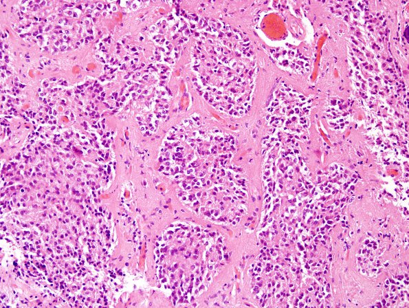 3B2 Cyst, pineal (Case 3) H&E 2