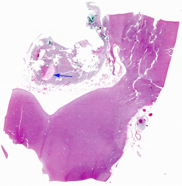 4A1 Cyst, pineal (Case 4) H&E whole mount