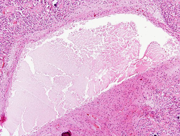 4A2 Cyst, pineal (Case 4) H&E 4A