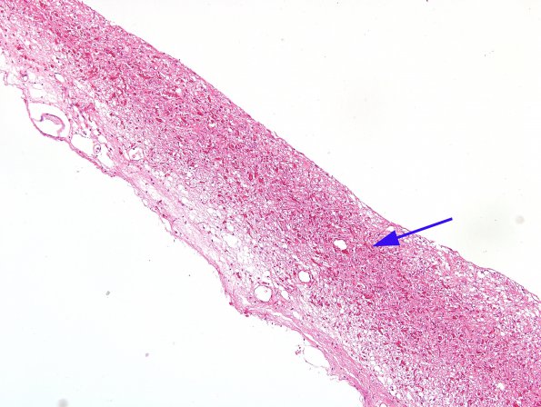 5A1 Cyst, pineal (Case 5) H&E 1A