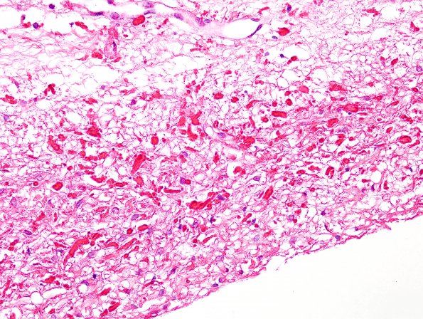 5A2 Cyst, pineal (Case 5) Rosenthals H&E 2A