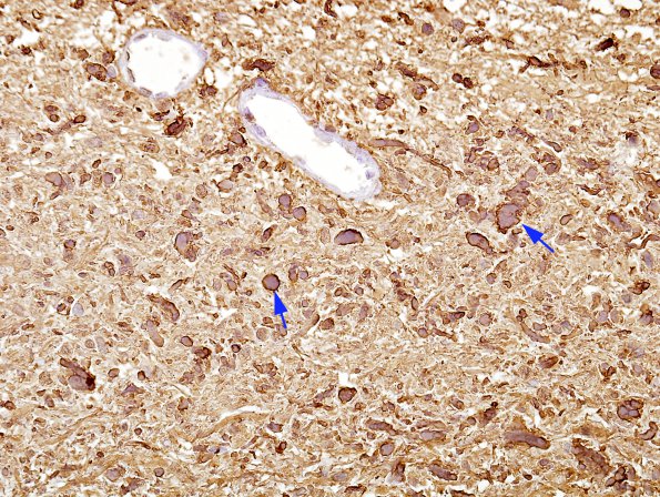 5B Cyst, pineal (Case 5) Rosenthals GFAP 2A