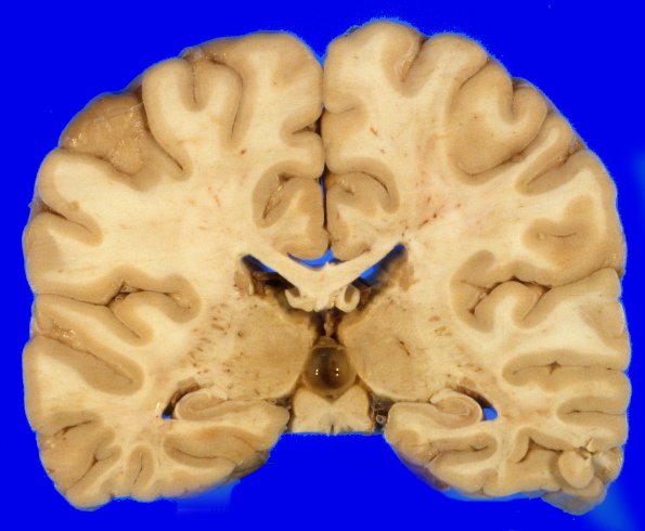 6A1 Cyst, pineal (Case 6) 2A