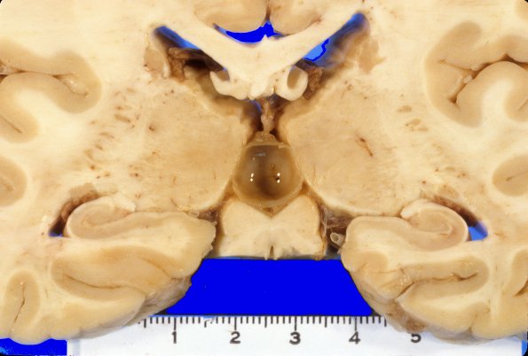 6A2 Cyst, pineal (Case 6) 1A