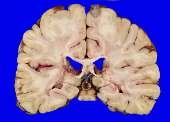 7A1 Piineal cyst (Case 7) 2A